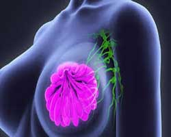 آیا پستان فرعی نشانه سرطان است؟