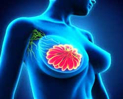 بیوپسی پستان در تشخیص سرطان سینه