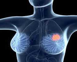 تشخیص بافت یا توده های سرطانی سینه با ماموگرافی
