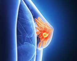 سرطان پستان سه‌گانه منفی