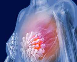 سونو گرافی و ماموگرافی در تشخیص سرطان سینه
