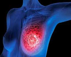 غربالگری سرطان پستان | تشخیص سرطان سینه