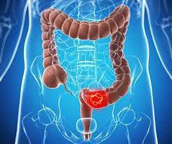رادیوتراپی سرطان کولون