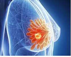 آیا درد پستان نشانه ی ابتلا به بیماری سرطان است؟