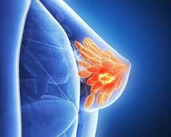 آیا سونوگرافی برای سینه بهتر است یا ماموگرافی؟