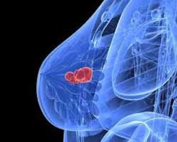 داشتن غده در سینه و درد در سینه چپ می تواند سرطان باشد ؟