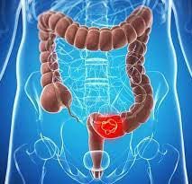 دکتر سرطان روده در داودیه