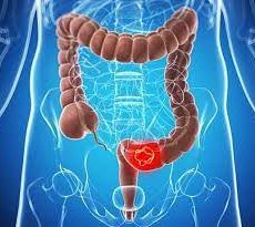 دکتر سرطان روده در داودیه