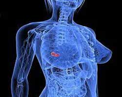دکتر سرطان پستان و سینه در ارم