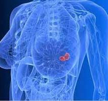 دکتر سرطان پستان و سینه در المهدی