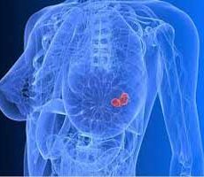 دکتر سرطان پستان و سینه در المهدی