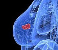 دکتر سرطان پستان و سینه در اکباتان