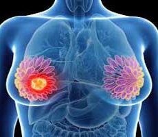 دکتر سرطان پستان و سینه در بولیوار