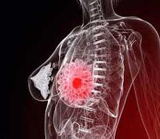 دکتر سرطان پستان و سینه در بیمه