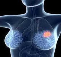 دکتر سرطان پستان و سینه در تجریش