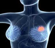 دکتر سرطان پستان و سینه در تجریش