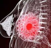دکتر سرطان پستان و سینه در دولت ( کلاهدوز )