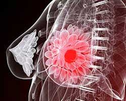 دکتر سرطان پستان و سینه در دولت ( کلاهدوز )