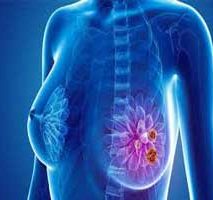 دکتر سرطان پستان و سینه در زعفرانیه