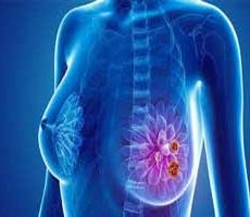 دکتر سرطان پستان و سینه در زعفرانیه