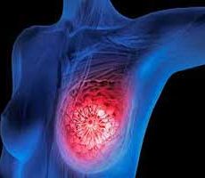 دکتر سرطان پستان و سینه در فرمانیه