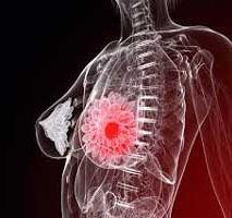 دکتر سرطان پستان و سینه در قبا