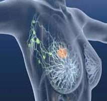 دکتر سرطان پستان و سینه در قیطریه