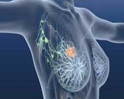 دکتر سرطان پستان و سینه در قیطریه