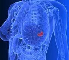 دکتر سرطان پستان و سینه در مخابرات