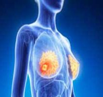 دکتر سرطان پستان و سینه در ولنجک