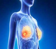 دکتر سرطان پستان و سینه در ولنجک