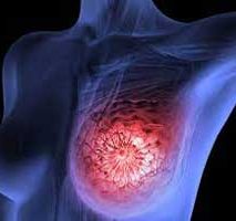 دکتر سرطان پستان و سینه در پردیسان