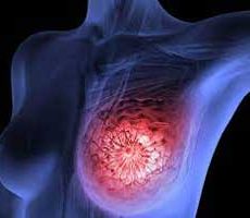 دکتر سرطان پستان و سینه در پردیسان