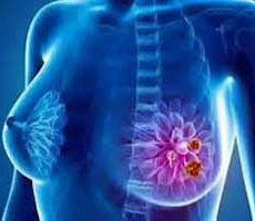 دکتر سرطان پستان و سینه در پونک