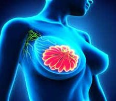 دکتر سرطان پستان و سینه در کوی نصر