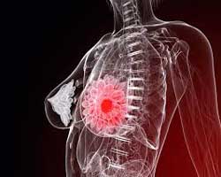 رادیوتراپی سرطان سینه