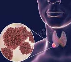 دکتر سرطان تیروئید در جماران