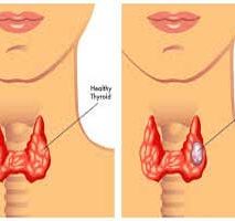 دکتر سرطان تیروئید در قیطریه