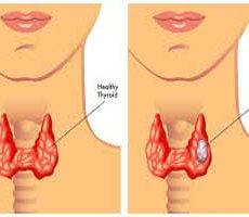 دکتر سرطان تیروئید در قیطریه