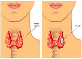 دکتر سرطان تیروئید در قیطریه