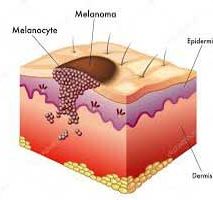 دکتر سرطان پوست در اندرزگو