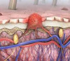 دکتر سرطان پوست در سردار جنگل