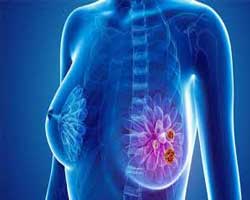 انواع سرطان سینه | درجه بندی سرطان سینه