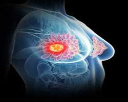 انواع سرطان سینه | سرطان های متداول و نادر پستان در زنان و مردان