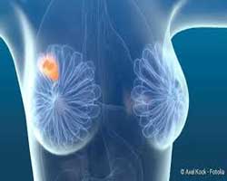 انواع سرطان سینه | سرطان پستان | جراح سینه