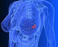 انواع سرطان سینه | سرطان پستان | درمان قطعی سرطان