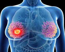 انواع سرطان پستان سینه | شایع ترین سرطان سینه