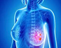 انواع نادر سرطان سینه کدام است؟