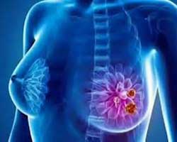 براکی تراپی یا پرتودرمانی داخلی برای سرطان سینه