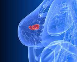 درمان سرطان پستان - جراحی سینه
